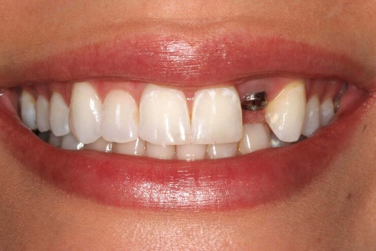 prosthodontics dental implantology sowmya multi speciality dental clinic