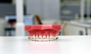 Ceramic Dental Braces - Sowmya Dental Clinic - Guntur