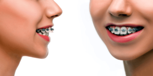 Fixed Dental Braces Sowmya Dental Clinic Guntur