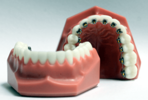 Lingual Dental Braces - Sowmya Dental Clinic - Guntur