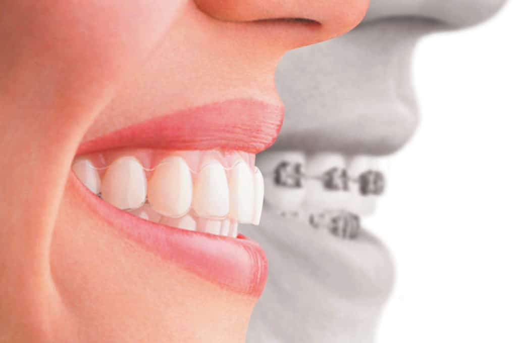Invisalign Dental Braces - Sowmya Dental Clinic - Guntur