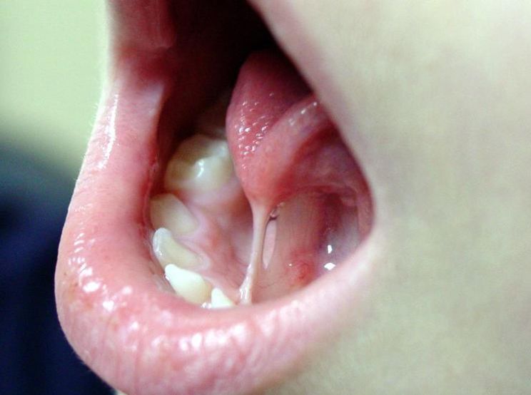 Best Lingual Frenectomy Tongue Tied Treatment in Guntur
