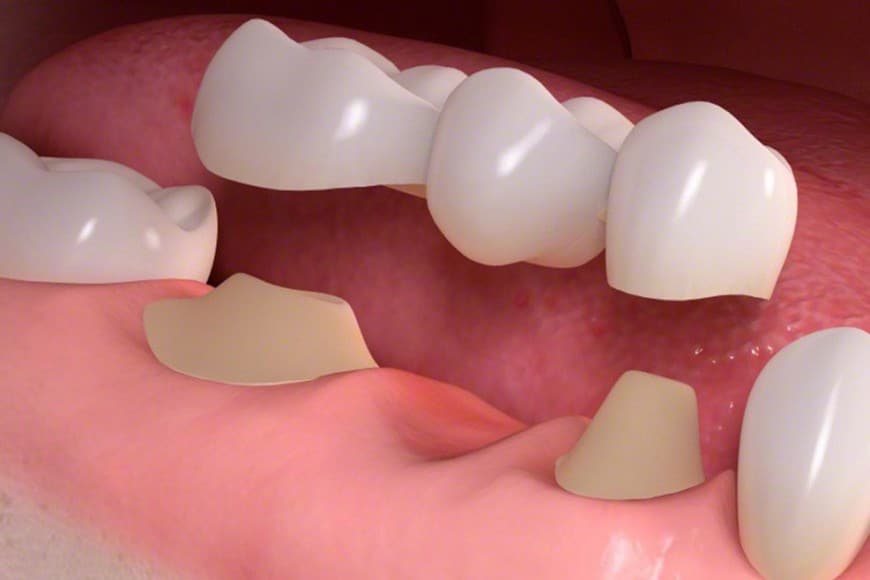 Dental Bridges Treatment - Sowmya Dental Clinic