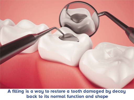 Dental Filling Treatment in Guntur Sowmya Multi Speciality Dental Clinic