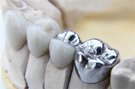 Dental Metal Crowns Treatment - Sowmya Dental Clinic