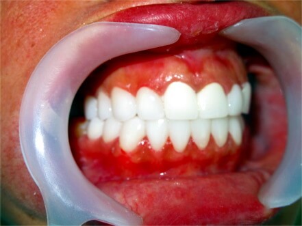 Zirconia Dental Crowns Treatment - Sowmya Dental Clinic