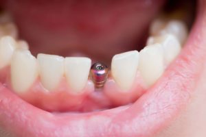 Best Single Tooth Dental Implants in Guntur - Sowmya Dental Clinic