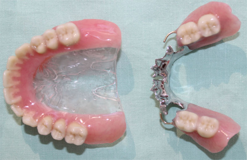 Full and Partial Dentures - Guntur - Sowmya Dental Clinic